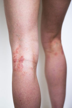 Psoriasis en la pierna