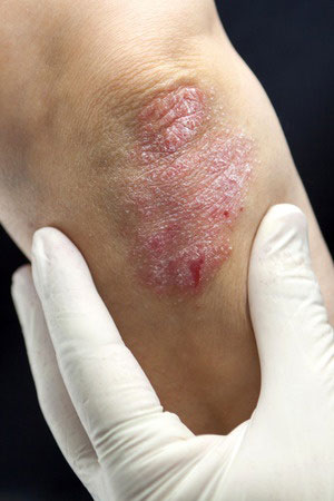 Psoriasis en el codo