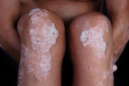 Psoriasis en las rodillas