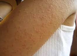 brazo con piel de gallina o queratosis pilar