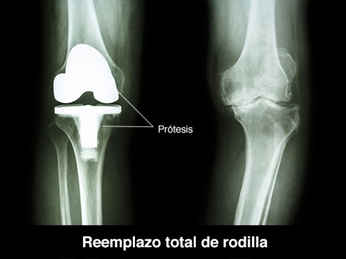radiografia mostrando reemplazo total de rodilla