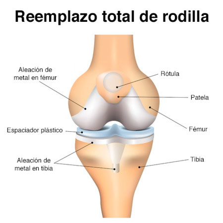 imagen de reemplazo total de rodilla mostrando componentes de la protesis