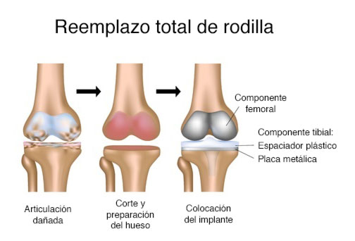 imagen de reemplazo total de rodilla