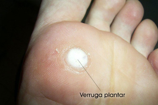 imagen de verruga plantar