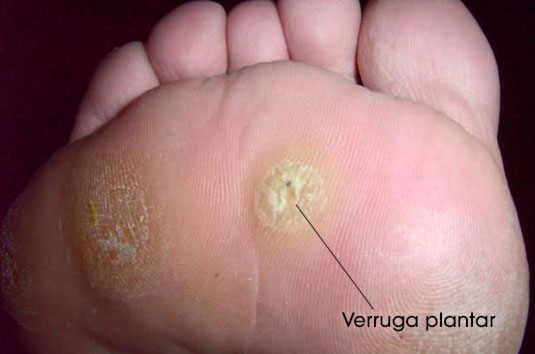 imagenes de verruga plantar