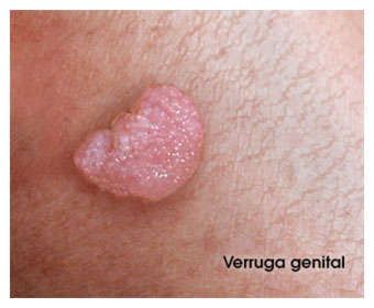 papiloma genital feminino