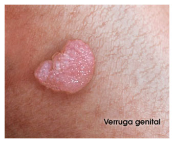 Verruga genital