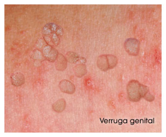 Displasia Cervical, Virus del papiloma humano verrugas en el ano - Virus del papiloma verrugas