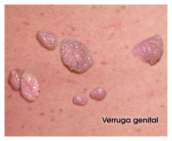 Imagenes virus del papiloma humano verrugas genitales Verrugas genitales papiloma
