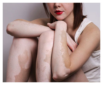 cuadro de vitiligo en mujer