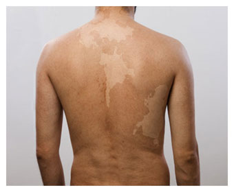 cuadro de vitiligo en espalda de hombre