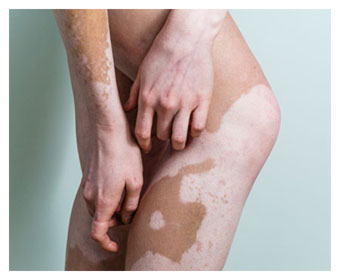 cuadro de vitiligo en piernas