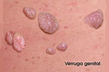 Fotos de Verrugas Genitales