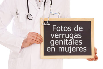 Fotos de verrugas genitales en mujeres