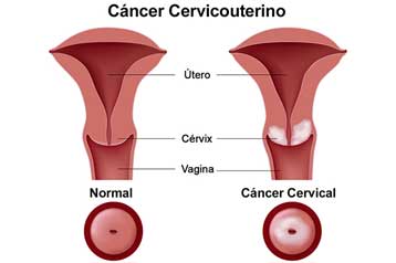 Qué es el cáncer cervicouterino?