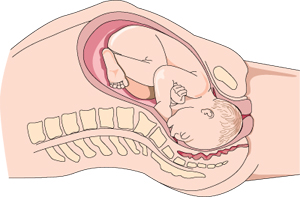 Diagrama de un bebé en el canal del parto