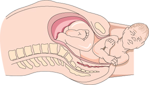 Diagrama de un bebé en el canal de parto coronación