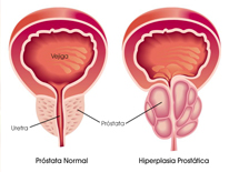 prostata agrandada