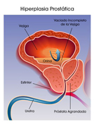 agrandamiento o hiperplasia de prostata