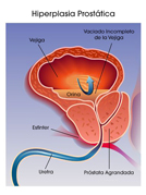 hiperplasia prostatica